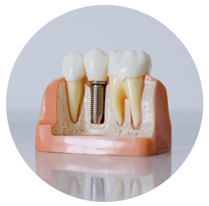 implantres dentarios 1